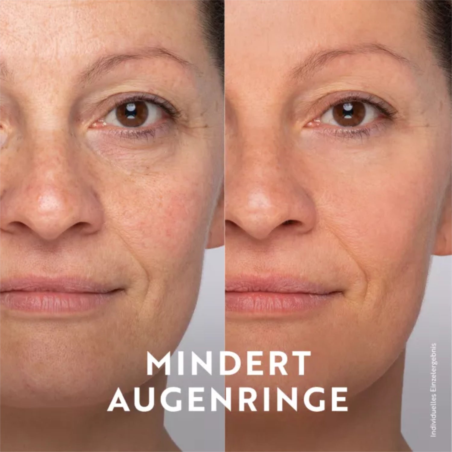 Vorher-Nachher-Foto einer Frauengesichtsbehandlung mit weniger Augenringen. Text: "MINDERT AUGENRINGE".