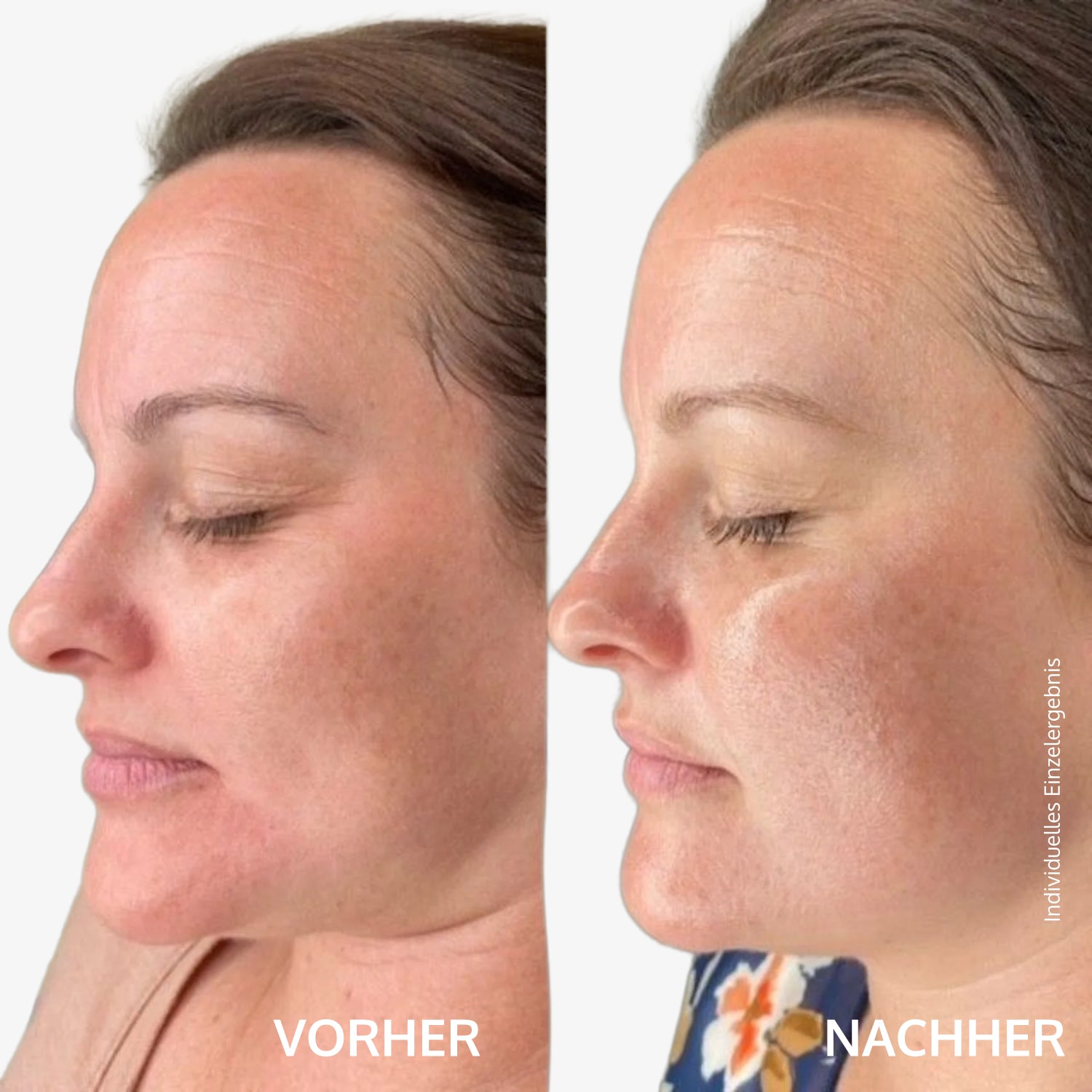 Profil eines Frauenkopfes im Seitenvergleich "Vorher" links und "Nachher" rechts mit unterschiedlicher Hautstruktur.