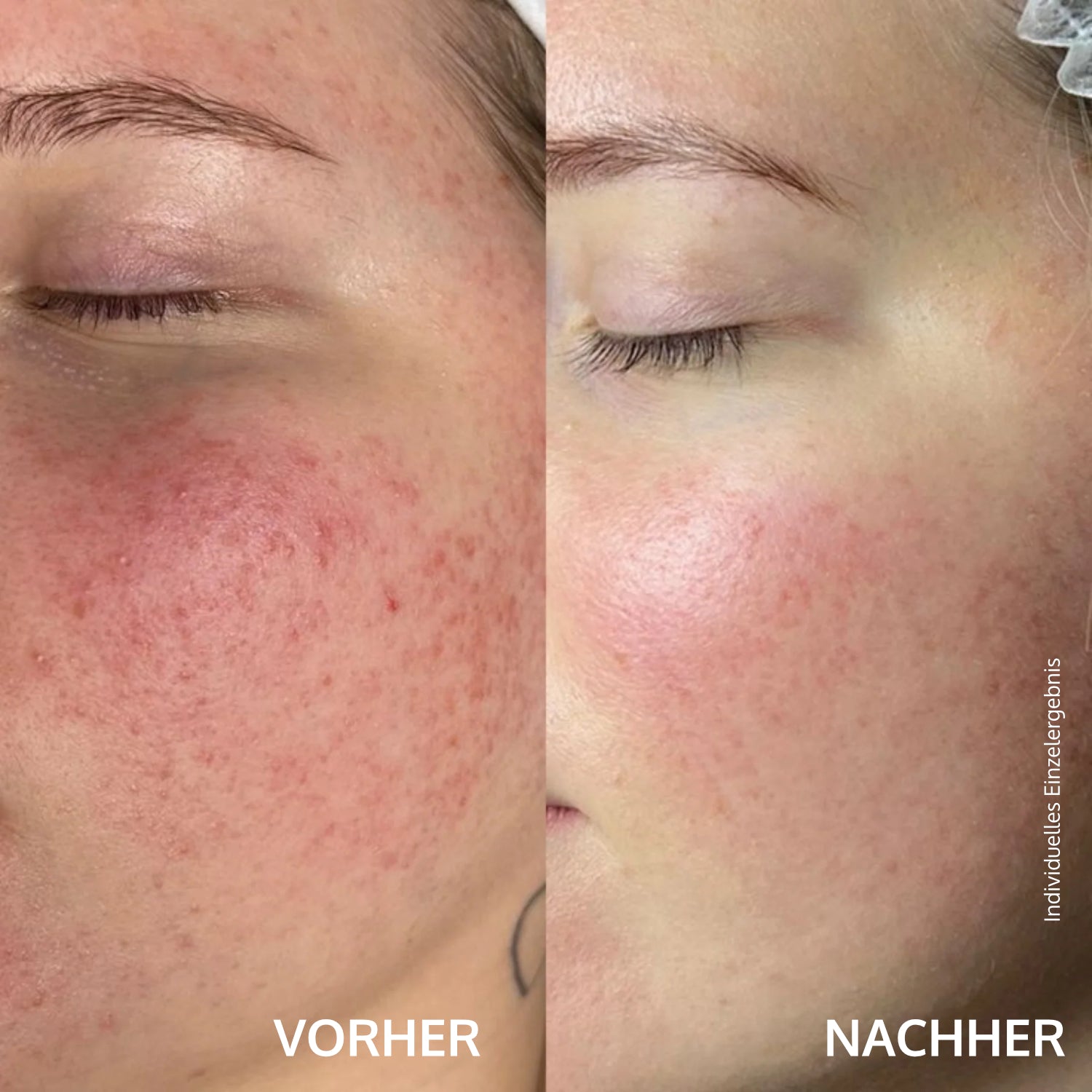 Vorher-nachher Foto einer Gesichtshaut mit weniger Rötungen und glatterem Teint nach der Behandlung.
