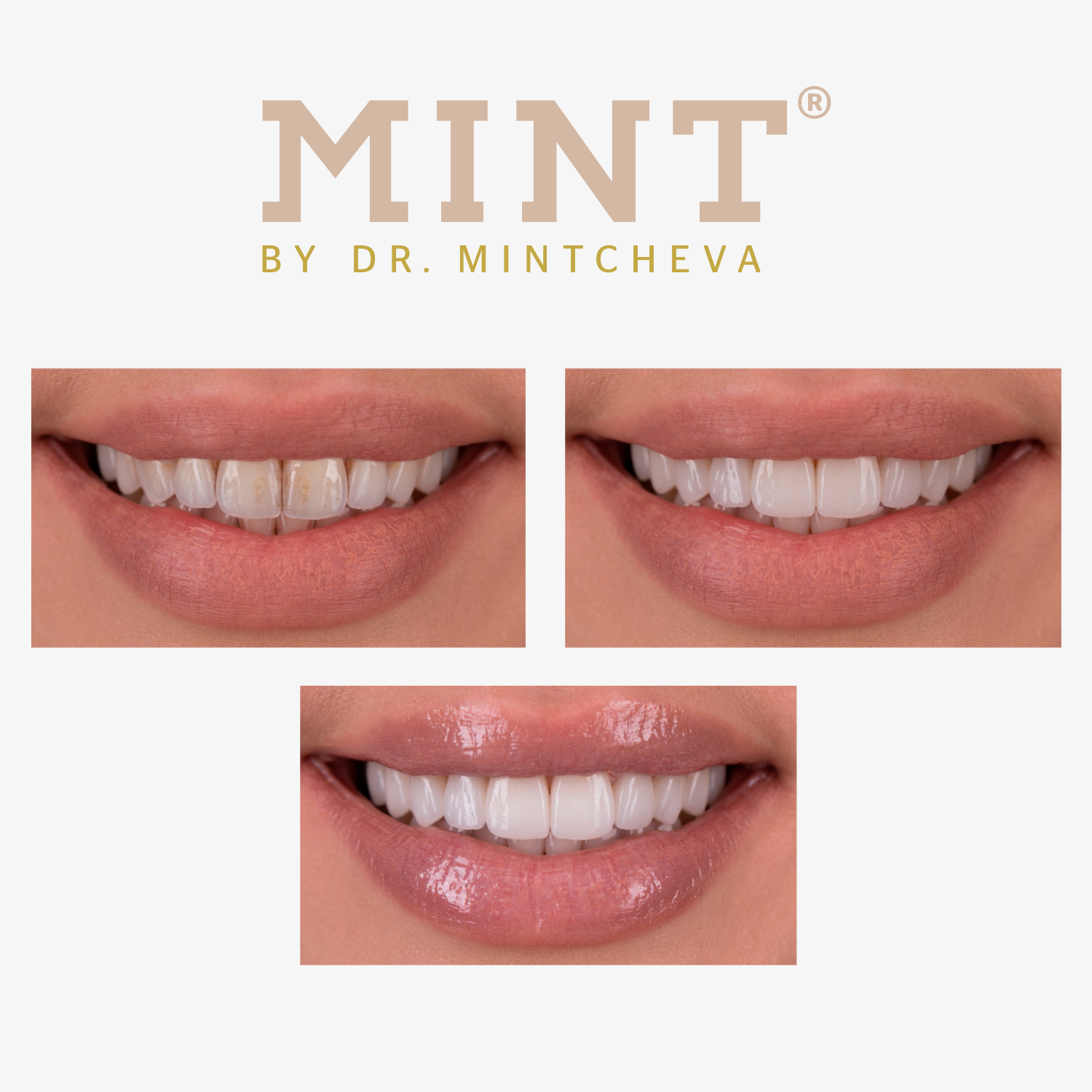Drei Bilder zeigen nahaufgenommene Lippen und Zähne vor und nach kosmetischer Zahnbehandlung. Text: "MINT BY DR. MINTCHEVA".