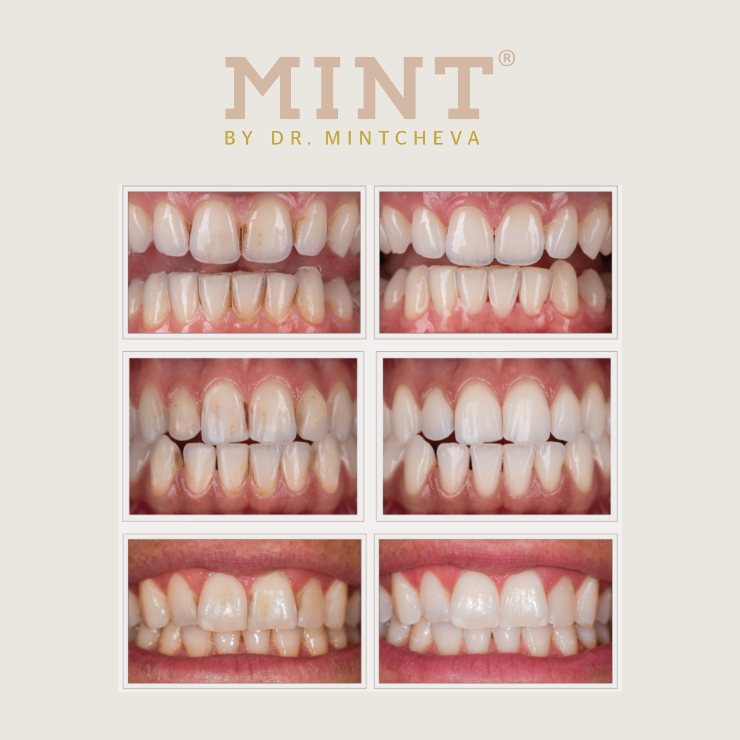 Sechs Vorher-Nachher-Bilder von Zähnen mit dem Text "MINT by Dr. Mintcheva" darüber.