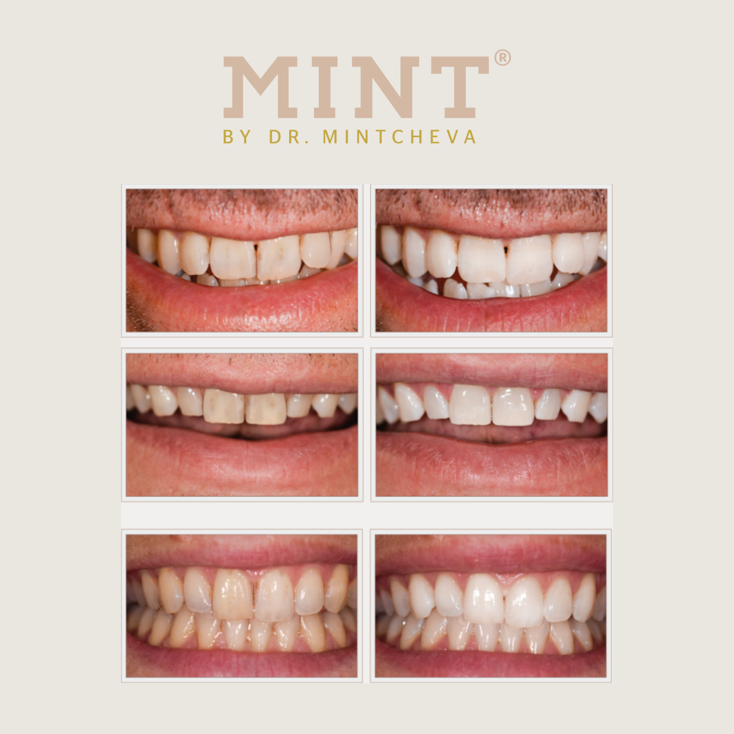 Vorher-nachher-Bilder zeigen Zähne mit kosmetischen Verbesserungen unter dem Logo "MINT BY DR. MINTCHEVA".