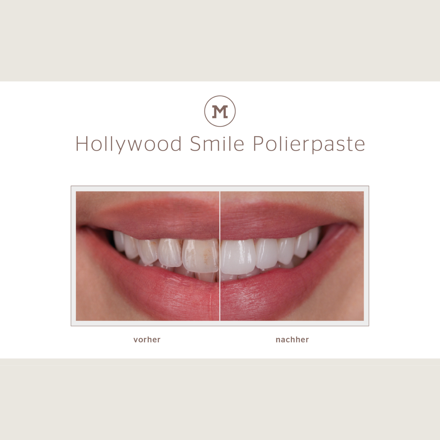 Vergleich eines Lächelns vor und nach der Anwendung von Hollywood Smile Polierpaste, mit sichtbarer Zahnaufhellung.