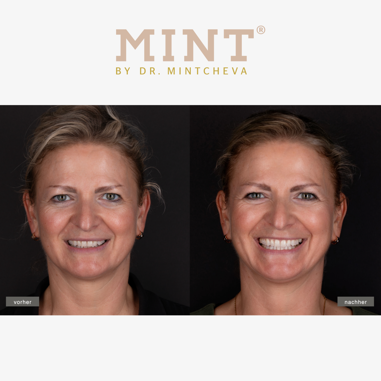 Zwei Fotos derselben Frau, links mit neutralem Gesichtsausdruck und rechts lächelnd. Oben steht "MINT BY DR. MINTCHEVA".