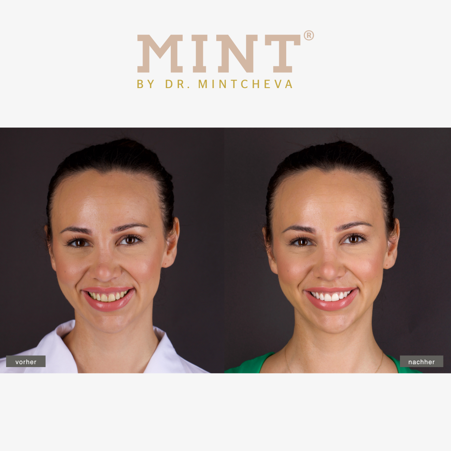 Vorher-nachher-Bild einer Frau mit unterschiedlichen Lächeln; links vorher, rechts nachher. Marke: MINT by Dr. Mintcheva.