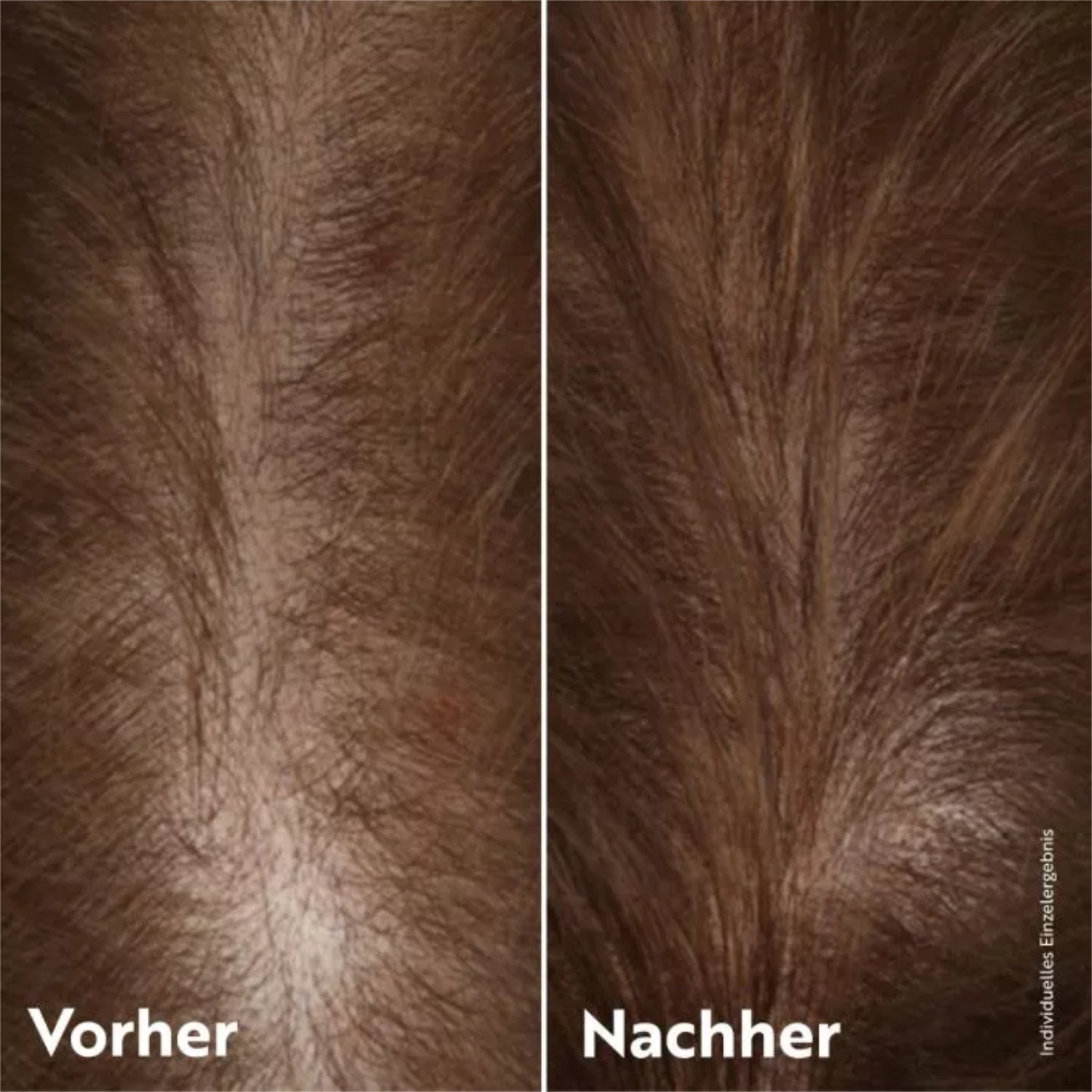 Vorher-Nachher-Bild einer Kopfhaut mit sichtbar mehr Haaren im rechten Bild.