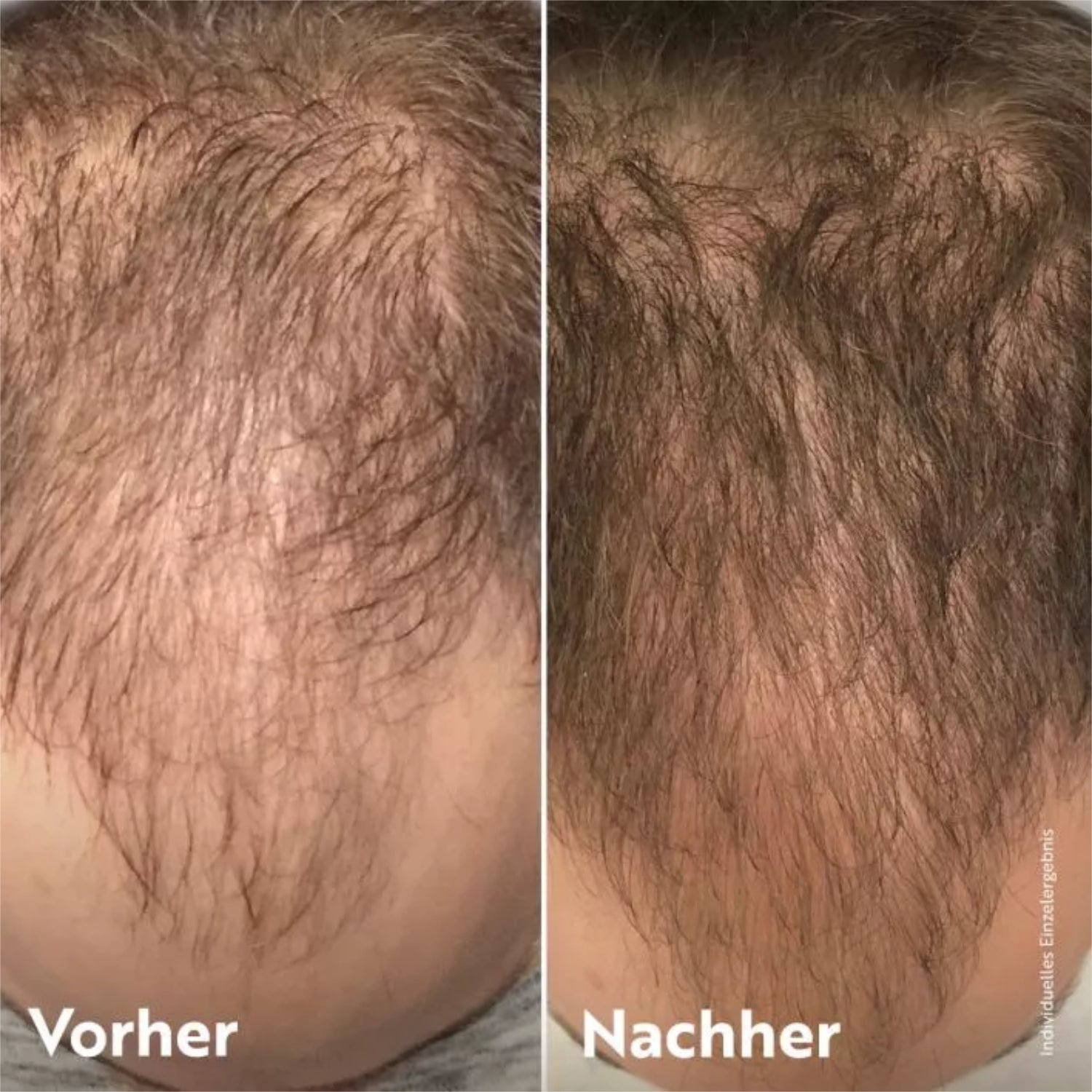 Vorher-Nachher-Foto von einer Kopfhaut mit sichtbarem Haarwachstum, links dünneres Haar, rechts dichteres Haar.